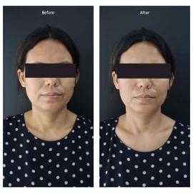 Botox result KOQ10